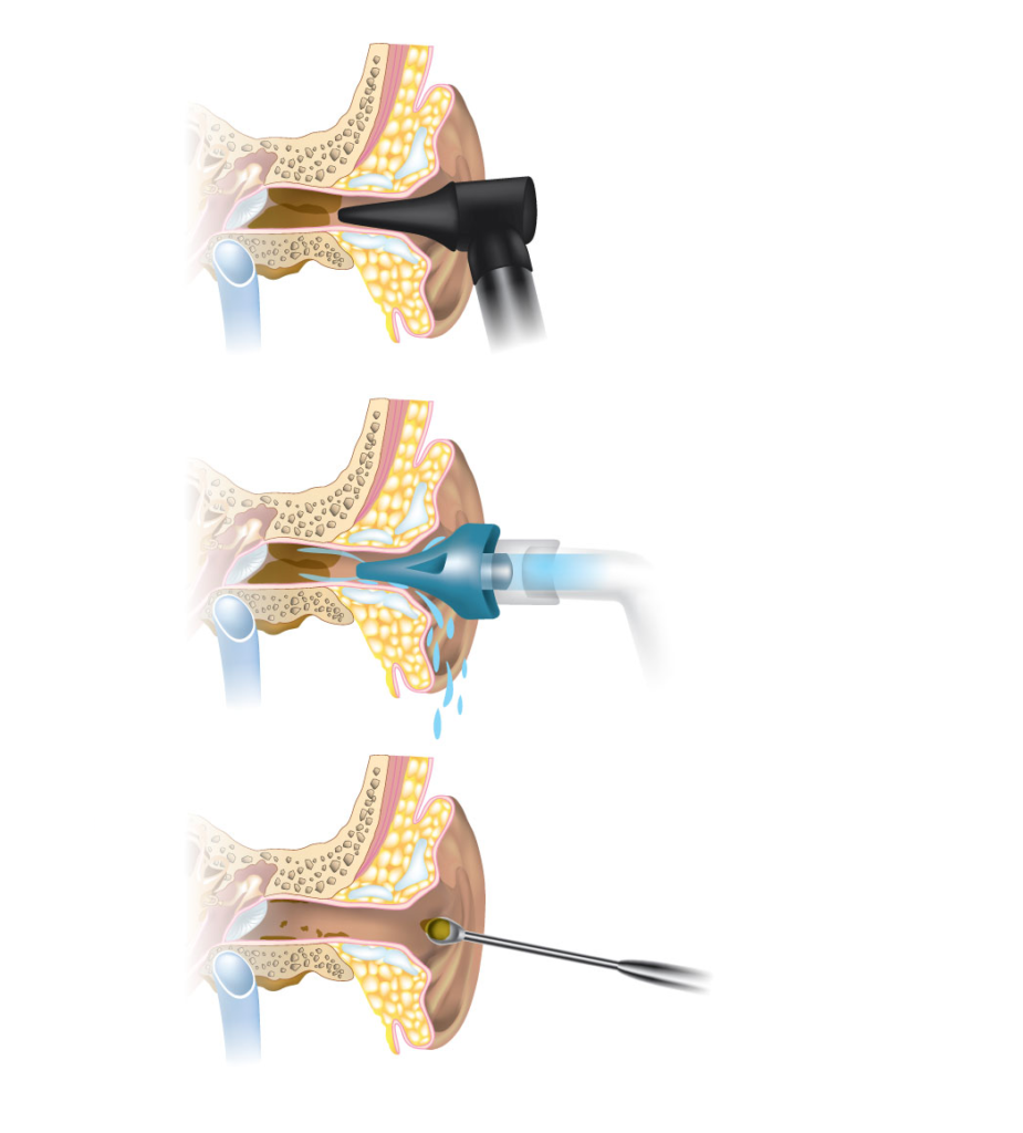 Ear Wax Removal London, Ear Microsuction