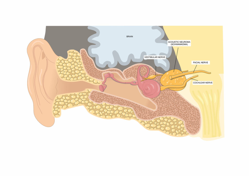 A Guide to Acoustic Neuroma (Vestibular Schwannoma) London Hearing